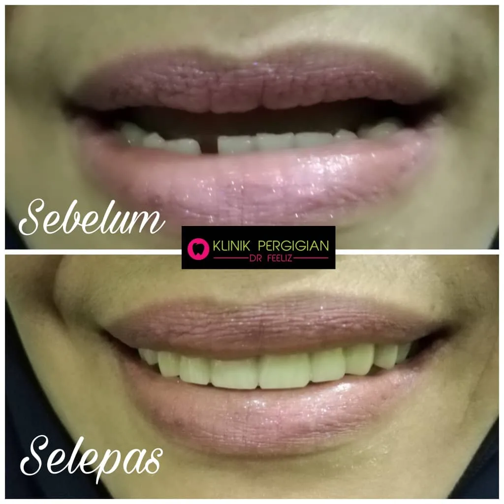 Dentures (gigi palsu) at Dr Feeliz