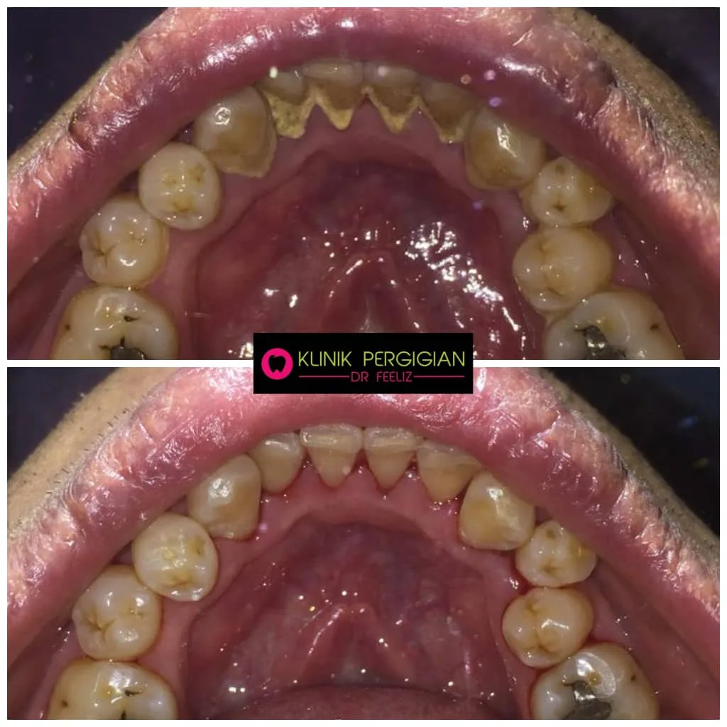 Scaling and polishing treatment at Dr Feeliz